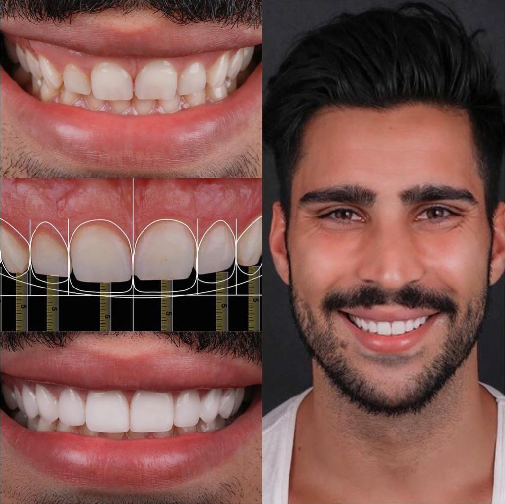 Smile Makeover Digital Smile Design Dubbo Crescent Dental 